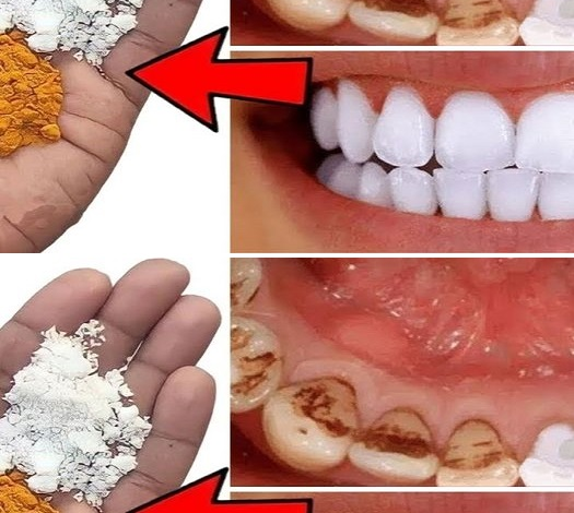 Ilumina tu sonrisa: un método rápido para blanquear tus dientes en casa