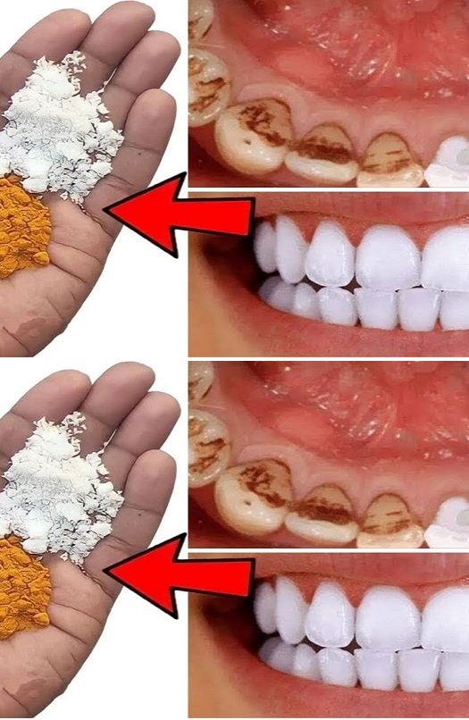 Ilumina tu sonrisa: un método rápido para blanquear tus dientes en casa