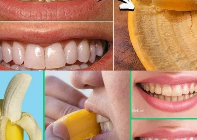 Secreto que los dentistas no quieren que sepas: ¡Elimina el sarro y blanquea los dientes en solo 2 minutos con cáscara de plátano!