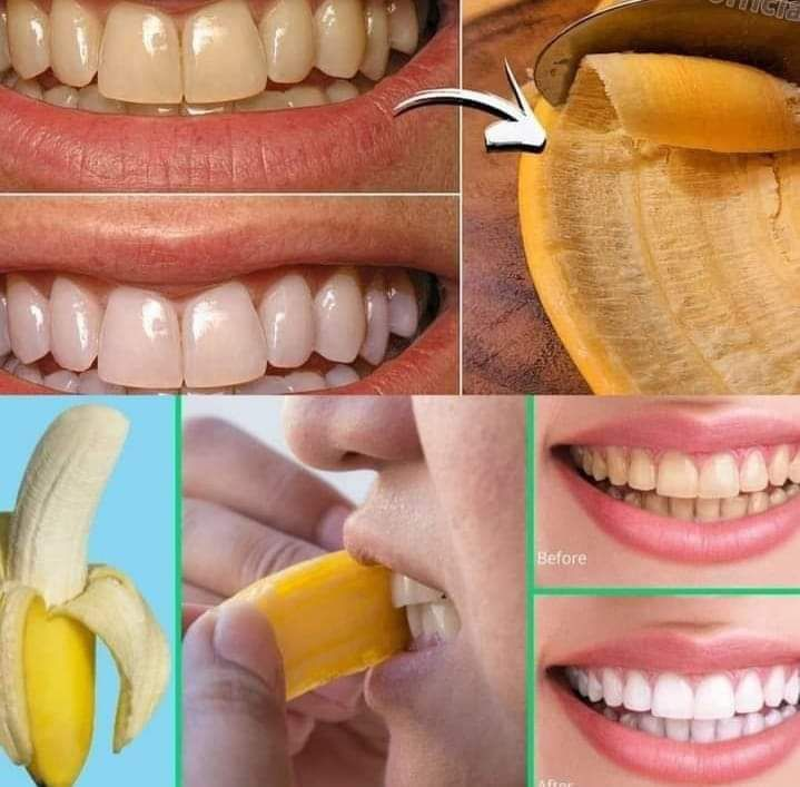 Secreto que los dentistas no quieren que sepas: ¡Elimina el sarro y blanquea los dientes en solo 2 minutos con cáscara de plátano!